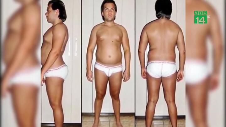 Chàng trai phẫu thuật thẩm mỹ 58 lần để có thân hình như búp bê