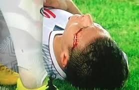 Rách mí mắt, Tiền vệ Quang Hải đội tuyển Olympic Việt Nam có gặp nguy hiểm không?