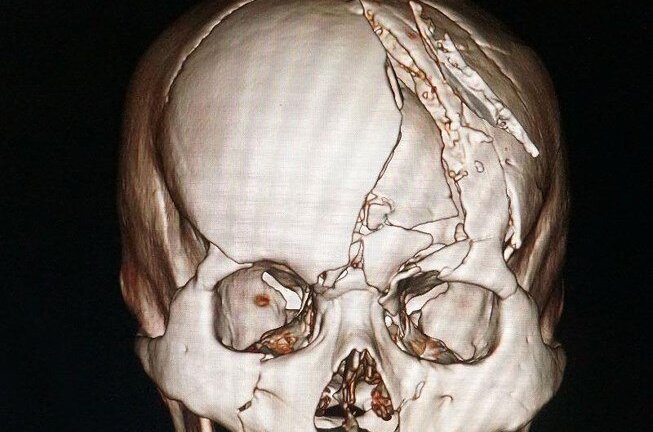 Bị tai nạn lún xương trán, người đàn ông nguy kịch