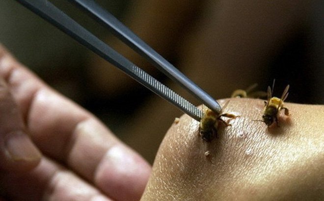 Bác sĩ bật báo động đỏ, cứu sống mẹ con sản phụ sốc phản vệ do ong đốt