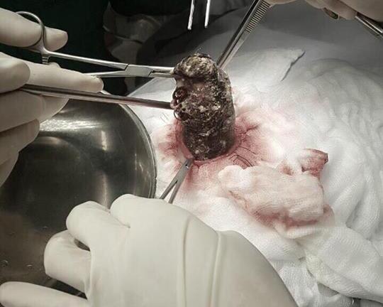 Tá hỏa phát hiện búi tóc nặng 1kg trong dạ dày bé gái