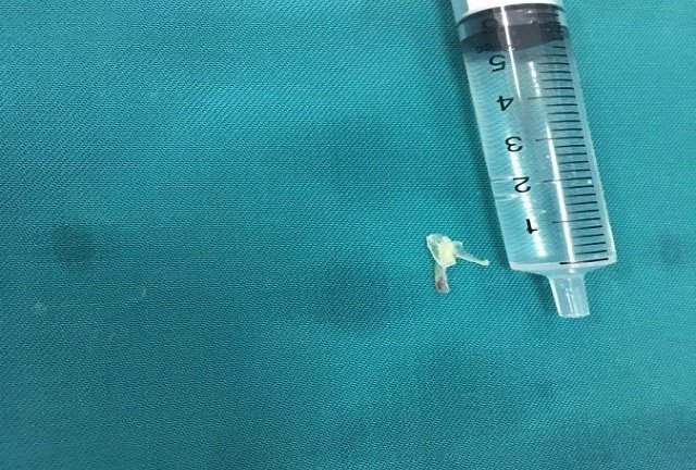 Bé 10 tháng tuổi mắc xương cá, 8 ngày mới được gắp ra vì ban đầu bác sĩ nhầm... viêm phế quản