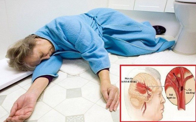 Khống chế tử thần đột quỵ não chỉ với 1 phút mỗi ngày