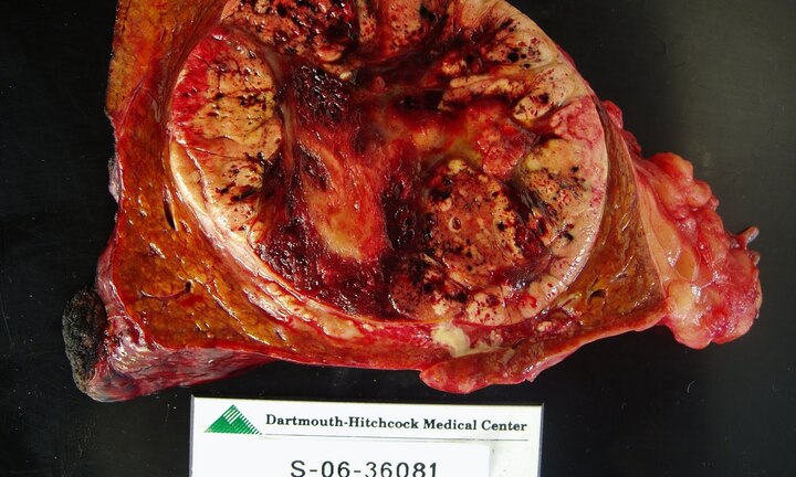 Đau bụng liên tục 5 tháng, đi khám mới biết bị ung thư gan