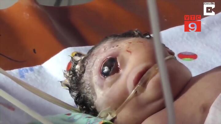 Bố mẹ đau đớn tột độ khi con chào đời chỉ có 1 mắt giữa trán