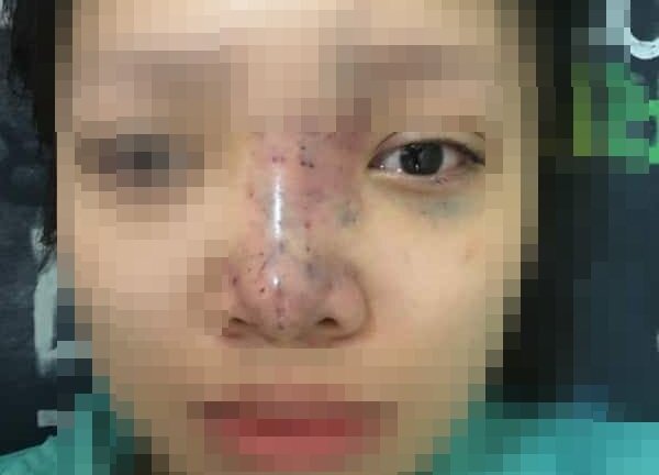 Nữ sinh 20 tuổi biến dạng mũi, có nguy cơ mù mắt vì tiêm filler trôi nổi
