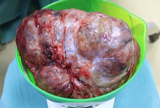 Cắt khối u ngực nặng gần 2kg cho người phụ nữ khốn khổ
