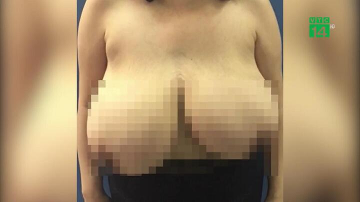 Ngực trái to gấp 5 lần ngực phải, người phụ nữ khốn khổ ngủ nghiêng