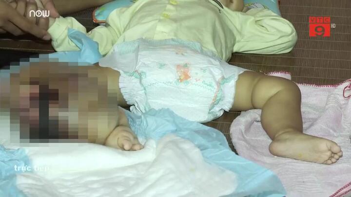 Mẹ khóc nghẹn nhìn con 14 tháng tuổi bị khối u quái ác hành hạ