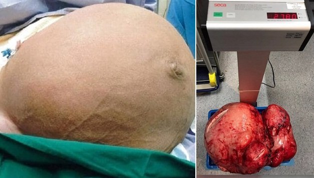 Khối u nặng 28 kg hành hạ, người phụ nữ khốn khổ nhiều năm trời