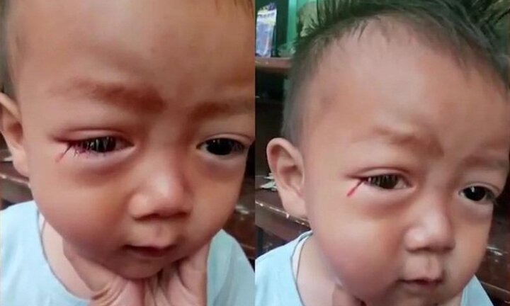 Mẹ hoảng hồn phát hiện con trai khóc ra 'máu'