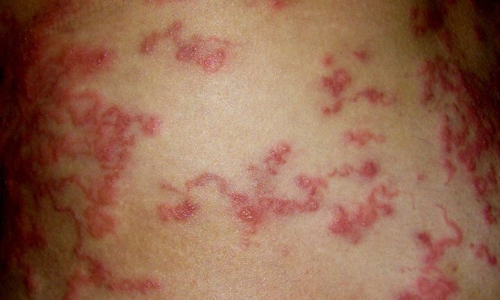 Thường xuyên trồng hoa, người phụ nữ bị nhiễm giun lươn