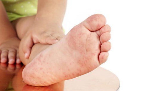 Chủng virus khiến 6 ca tử vong vì tay chân miệng gần đây nguy hiểm thế nào?