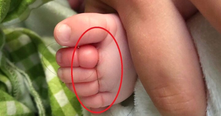 Sợi tóc của mẹ thít chặt vào chân, bé 10 tuần tuổi suýt phải cắt cụt 4 ngón