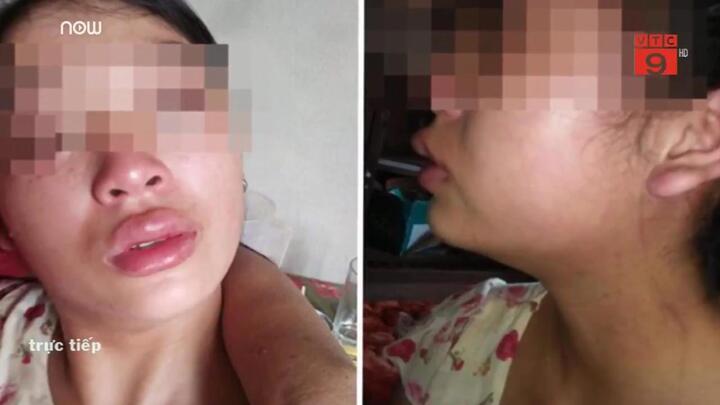 Thiếu nữ 16 tuổi bị chồng bạo hành, lên Facebook cầu cứu: Chính quyền xã vào cuộc