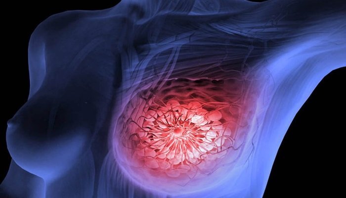 Bệnh ung thư nhiều phụ nữ Việt mắc nhất, đang tấn công các thiếu nữ trẻ