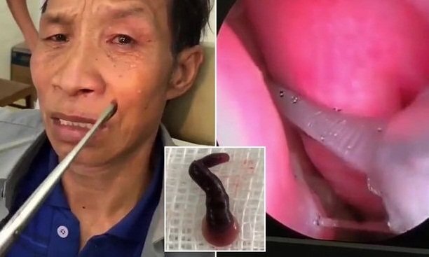 Clip: Đỉa hút máu trú ngụ trong mũi người đàn ông Điện Biên