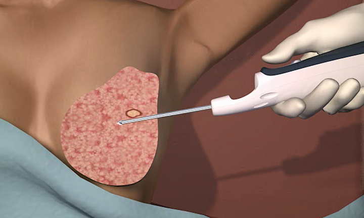 Bệnh viện đầu tiên ở TP.HCM dùng kỹ thuật hút chân không sinh thiết khối u tuyến vú