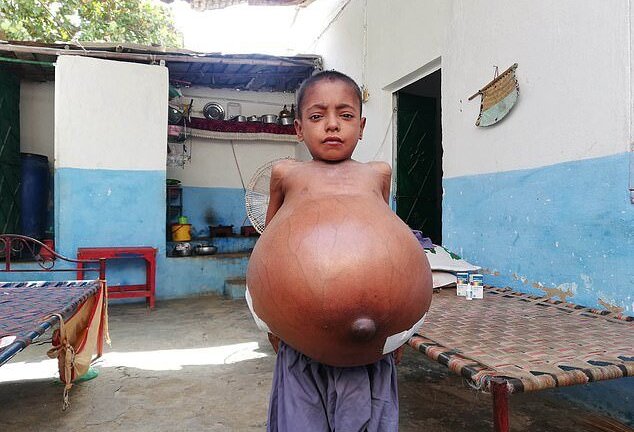 Clip: Bé trai 9 tuổi bụng phình to vì căn bệnh hiếm gặp