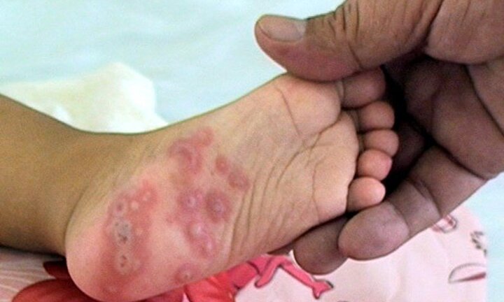 Một bệnh nhi mắc tay chân miệng thiệt mạng ở Đà Nẵng