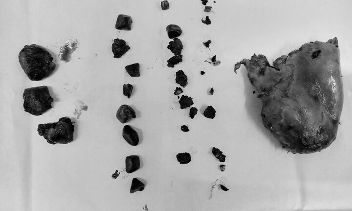 Cứu sống người đàn ông ngoại quốc mang túi mật chứa gần 50 viên sỏi