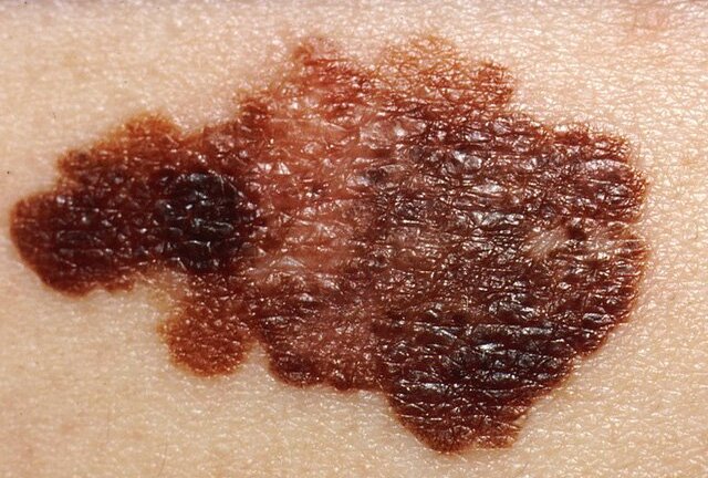 Cách nhận biết nốt ruồi nguy hiểm bạn có thể tự thực hiện tại nhà