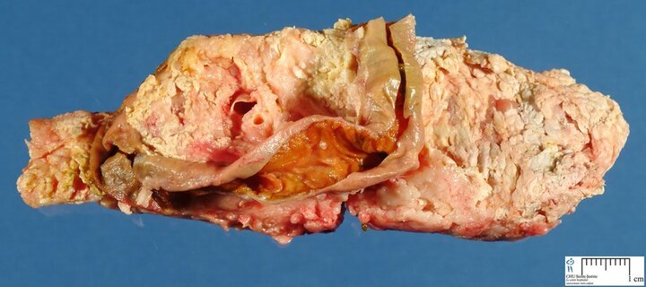 Bé trai 11 tuổi viêm tụy cấp, liên tục nôn ra máu ồ ạt không cầm được