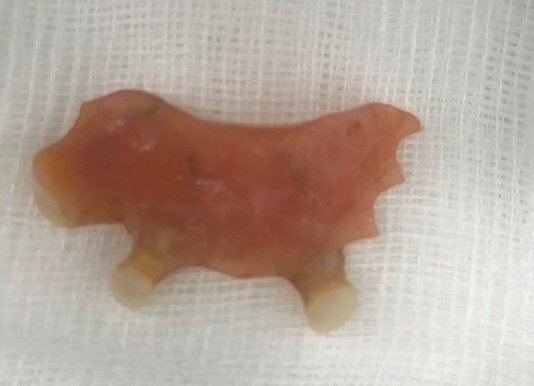 Nội soi gắp cung răng trong thực quản người phụ nữ ở Quảng Nam