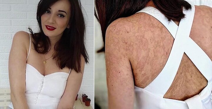 Uống vài viên kháng sinh, cô gái xinh đẹp bị bỏng 90% da