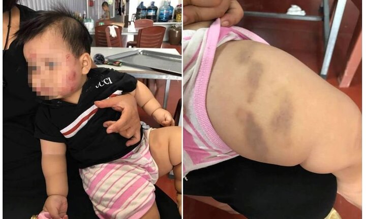 Phụ huynh tố trẻ 11 tháng tuổi bị cắn khắp mặt ở lớp mầm non