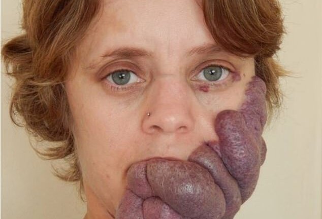 Clip: Người phụ nữ bị coi như ‘quái vật’, sống khổ sở với vết chàm trên mặt