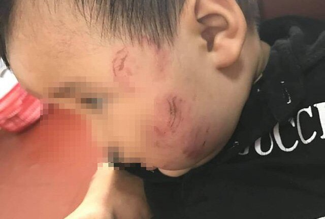 Bé 11 tháng tuổi bầm tím khắp người sau khi gửi trẻ tại Bắc Giang