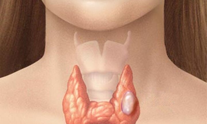 Video: Bác sĩ đốt sóng cao tần điều trị khối u tuyến giáp lành tính