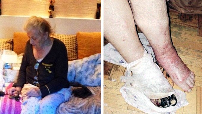 Bệnh nhân hoại tử chân phải, bác sĩ cắt cụt luôn cả chân trái