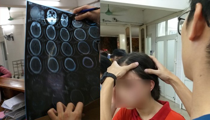 Bị mẹ kế đánh đến rạn đầu, bé gái 14 tuổi ở Hà Nội cầu cứu mẹ đẻ