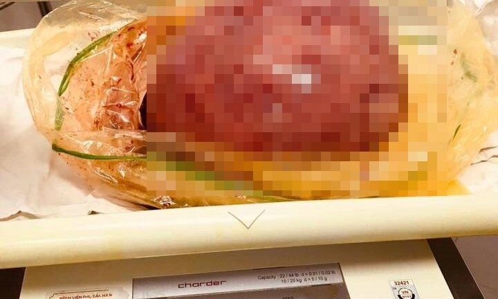 Người phụ nữ có khối u xơ tử cung nặng bằng bé 9 tháng tuổi