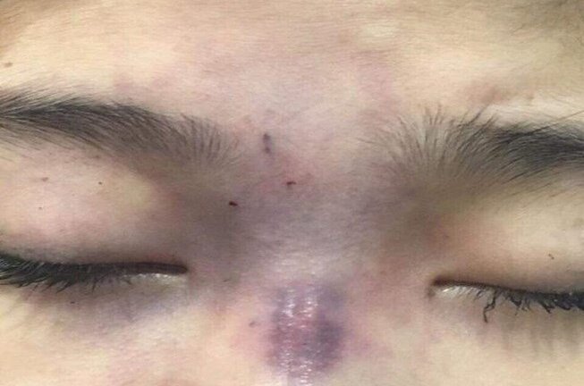 Video: Cô gái mù mắt sau khi bạn trai tiêm filler nâng mũi