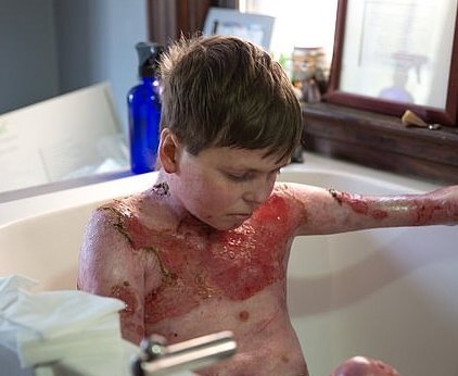 Căn bệnh quái gở khiến cậu bé 15 tuổi liên tục rách toạc da trong đau đớn