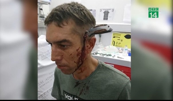 Bị dao đâm xuyên đầu vẫn tỉnh táo đạp xe đến bệnh viện, hỏi 'có bác sĩ nào rảnh không?'