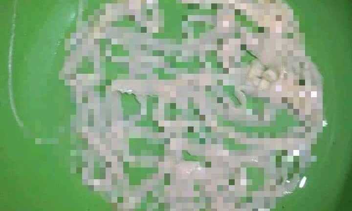 Sán xơ mít dài 8m ký sinh trong cơ thể người đàn ông