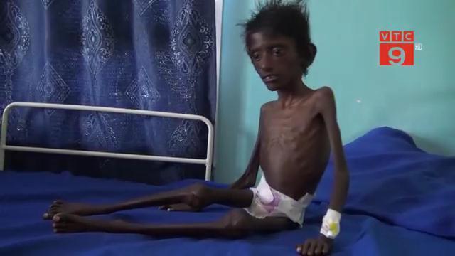 Bé trai Yemen gầy trơ xương, 5 tuổi chỉ nặng 8 kg khiến cả thế giới xót xa