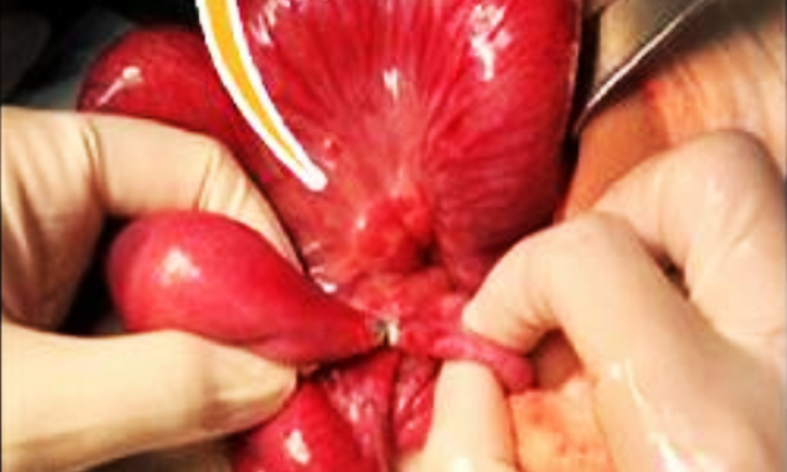 Nuốt quà sinh nhật mẹ tặng, bé gái 6 tuổi ở TP.HCM thủng ruột nguy kịch