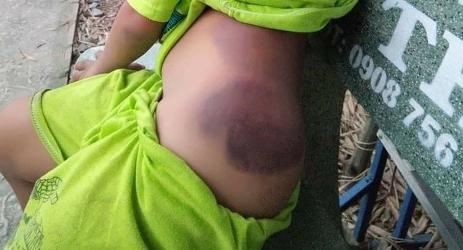 Bé trai khuyết tật bị cô giáo đánh bầm tím: Bộ Giáo dục và Đào tạo yêu cầu xác minh