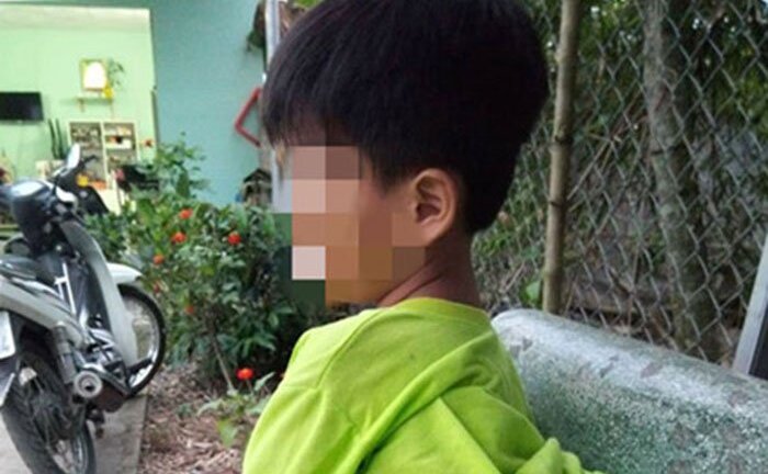 Tạm đình chỉ 15 ngày cô giáo Long An đánh học sinh khuyết tật bầm tím