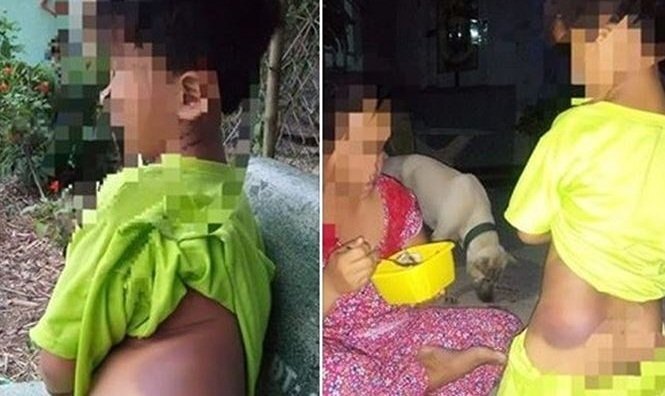 Cô giáo đánh học sinh khuyết tật bầm tím: Mẹ bé trai tiết lộ điều không ngờ