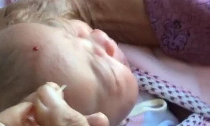 Dùng kim đâm vào trán trẻ sơ sinh chữa bệnh, chuyên gia kinh ngạc