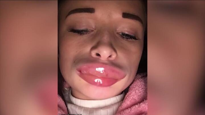 Tiêm chất làm đầy tại nhà, nữ y tá sưng vều môi như muốn phát nổ