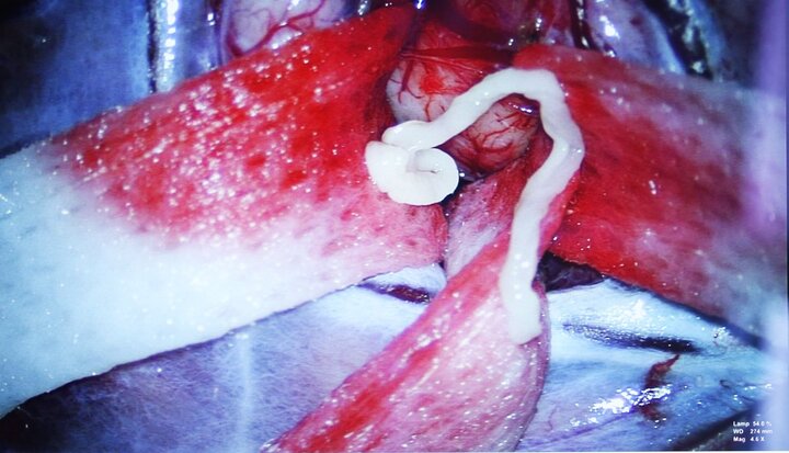 Người đàn ông 52 tuổi bị sán nhái tấn công não