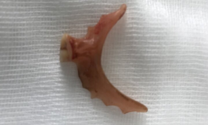 Lấy cung răng 35mm trong thực quản người phụ nữ