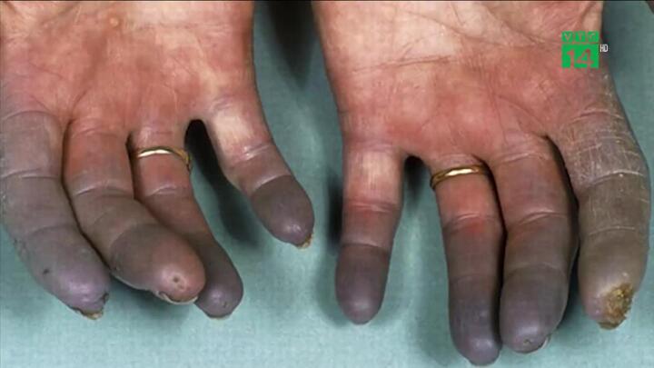 Hút thuốc suốt nhiều năm, đầu ngón tay đen sì, suýt phải cắt cụt